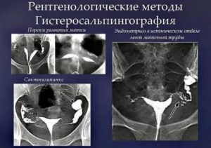 Сколько нельзя беременеть после гистеросальпингография