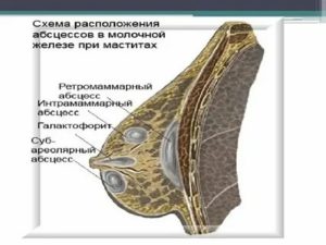 Что такое абсцессы в грудных железах