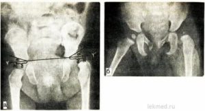Что такое окостенение тазобедренных суставов у грудничков