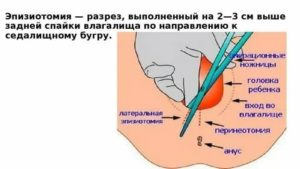 Когда можно садиться после родовых швов наружных