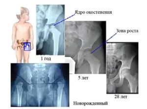 Что такое окостенение тазобедренных суставов у грудничков