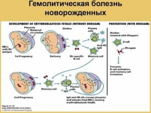 Как делают переливание крови новорожденным при резус конфликте