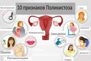 Как лечить поликистоз яичников для планирования беременности