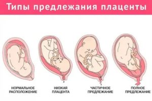 Когда поднимается плацента при низкой плацентации какие ощущения