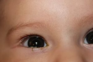 Что делать если слезятся глаза у новорожденных детей