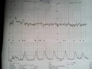 Что означают цифры на ктг на мониторе