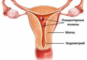 Может ли полип плацентарный выйти с месячными