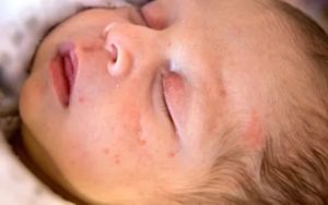 Что такое везикулезная сыпь у новорожденного
