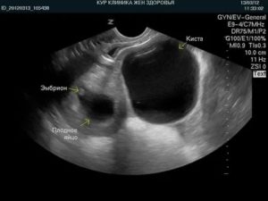 Можно ли беременеть при кисте яичника желтого тела