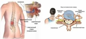 Можно ли беременеть при межпозвоночной грыже поясничного отдела