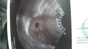 Коричневые выделения на 4 недели беременности от зачатия что происходит