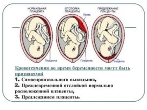 Можно ли заниматься сексом во время отслойки плаценты