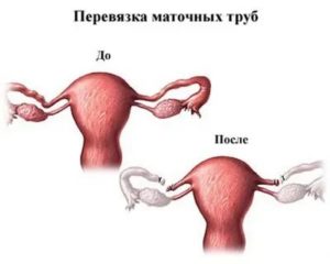 Можно ли сделать стерилизацию после родов женщине