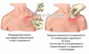 Можно ли беременеть с кардиостимулятором