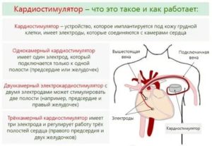 Можно ли беременеть с кардиостимулятором