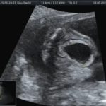 Анализ на тромбофилию при планировании беременности что это такое
