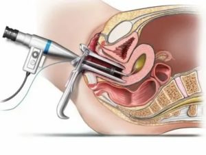 Когда после биопсии шейки матки можно беременеть после