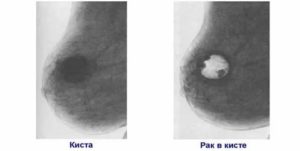 Может ли киста грудной железы перерасти в рак