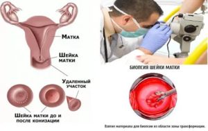 Когда после биопсии шейки матки можно беременеть после