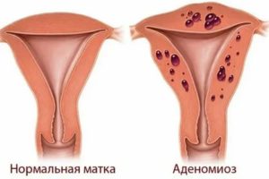 Чем лечить аденомиоз при планировании беременности