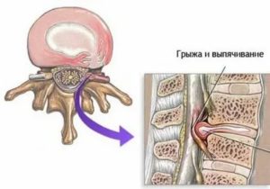 Можно ли беременеть при межпозвоночной грыже поясничного отдела