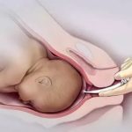 Почему не раскрывается шейка матки при родах причины и последствия