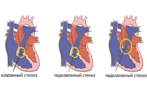 Что такое клапанный стеноз легочной артерии у плода