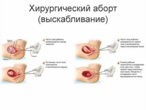 Можно ли забеременеть после таблеток для выкидыша