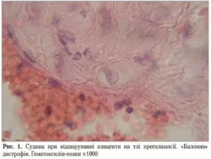 Что такое тромбоз в плаценте