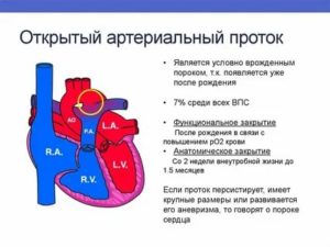 Что такое открытый артериальный проток у новорожденного