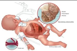 Что такое некротизирующий энтероколит у новорожденных