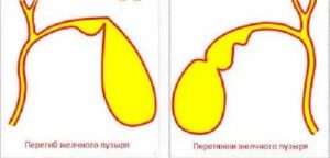 Что такое перетяжка желчного пузыря у новорожденного