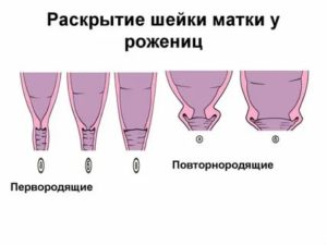 Что делать если схватки начались а шейка матки не открывается