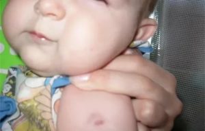 Как должна выглядеть прививка бцж у новорожденных
