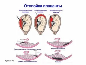 Можно ли заниматься сексом во время отслойки плаценты