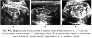 Что такое лоханка в почках у плода на 34-35 недели