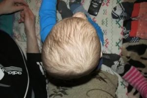Что делать если новорожденный отлежал голову