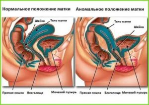 Можно ли беременеть при загибе матки