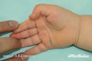 Как разогнуть большой палец у новорожденного