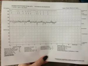 Что означает ктг плода подозрительная