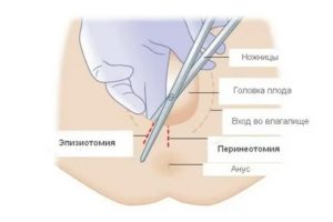 Когда можно садиться после родовых швов наружных