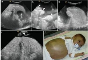 Почему может быть увеличена печень у плода