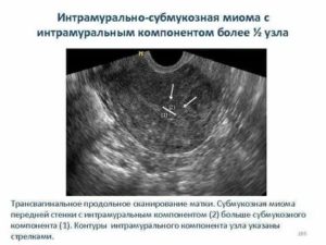 Кто беременел при субмукозной миоме