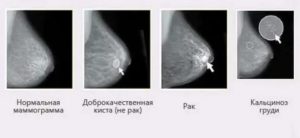 Может ли киста грудной железы перерасти в рак