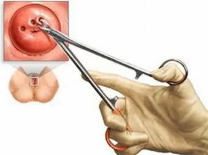Когда после биопсии шейки матки можно беременеть после