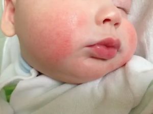 Как и чем убрать аллергию у новорожденного на лице