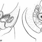 Для чего после переноса эмбриона назначают фраксипарин