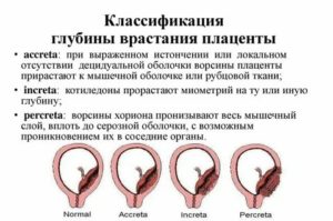 Что делать чтобы плацента не приросла к матке