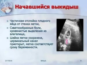 Как правильно лежать при отслойке плодного яйца