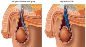 Можно ли вылечить бесплодие если вылечить варикоцеле